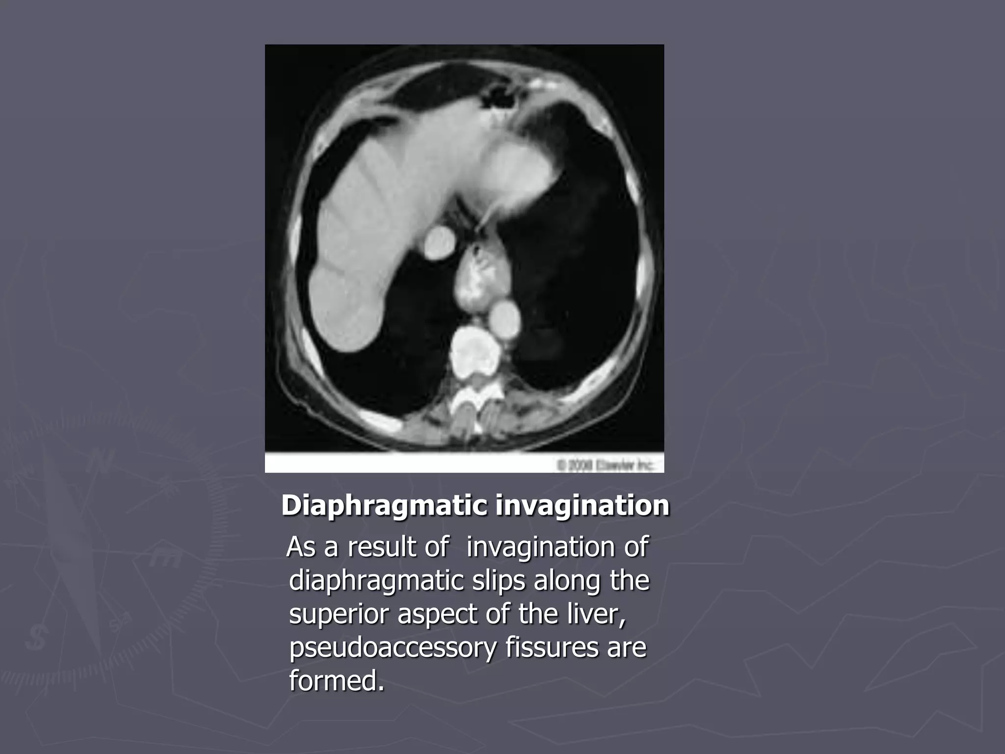 Diaphragmatic invagination
As a result of invagination of
diaphragmatic slips along the
superior aspect of the liver,
pseudoaccessory fissures are
formed.
 