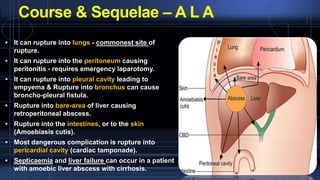 Liver - Surgical Anatomy, Abscess and Liver - Tumours | PDF