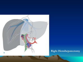 Right Hemihepatectomy 