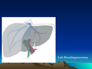 Left Hemihepatectomy 