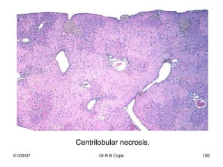 Centrilobular necrosis.
01/05/07          Dr R B Cope        100
 