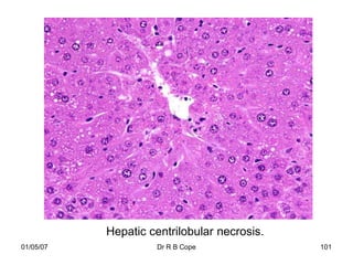Hepatic centrilobular necrosis.
01/05/07            Dr R B Cope              101
 