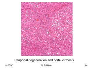 Periportal degeneration and portal cirrhosis.
01/05/07                       Dr R B Cope                 104
 