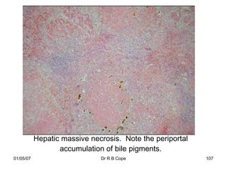 Hepatic massive necrosis. Note the periportal
                  accumulation of bile pigments.
01/05/07                      Dr R B Cope                  107
 