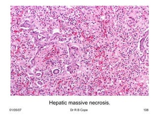 Hepatic massive necrosis.
01/05/07           Dr R B Cope         108
 