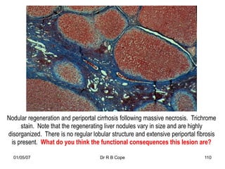Nodular regeneration and periportal cirrhosis following massive necrosis. Trichrome
     stain. Note that the regenerating liver nodules vary in size and are highly
disorganized. There is no regular lobular structure and extensive periportal fibrosis
 is present. What do you think the functional consequences this lesion are?

  01/05/07                           Dr R B Cope                                110
 