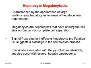 Hepatocyte Megalocytosis.
•     Characterized by the appearance of large
      multinucleate hepatocytes in areas of hepatocellular
      regeneration.

•     Megalocytes are hepatocytes that have undergone cell
      division but cannot complete cell separation.

•     Sign of frustrated or ineffective hepatocyte proliferation
      i.e. suggests a blockage in the cell division process.

•     Classically associated with the pyrrolizidine alkaloids,
      but also occur with several hepatic carcinogens.


01/05/07                    Dr R B Cope                       112
 
