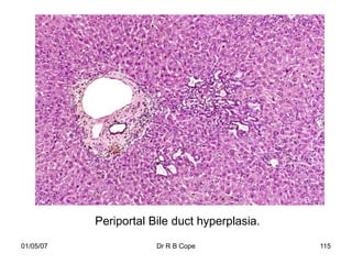 Periportal Bile duct hyperplasia.

01/05/07               Dr R B Cope             115
 