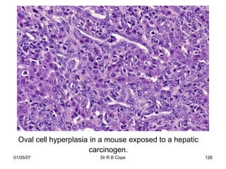 Oval cell hyperplasia in a mouse exposed to a hepatic
                        carcinogen.
01/05/07                  Dr R B Cope                     126
 