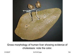 Gross morphology of human liver showing evidence of
               cholestasis: note the color.
01/05/07                 Dr R B Cope                     134
 