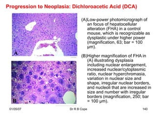 Progression to Neoplasia: Dichloroacetic Acid (DCA)

                               (A)Low-power photomicrograph of
                                  an focus of hepatocellular
                                  alteration (FHA) in a control
                                  mouse, which is recognizable as
                                  dysplastic under higher power
                                  (magnification, 63; bar = 100
                                  µm).

                               (B)Higher magnification of FHA in
                                  (A) illustrating dysplasia
                                  including nuclear enlargement,
                                  increased nuclear/cytoplasmic
                                  ratio, nuclear hyperchromasia,
                                  variation in nuclear size and
                                  shape, irregular nuclear borders,
                                  and nucleoli that are increased in
                                  size and number with irregular
                                  borders (magnification, 250; bar
                                  = 100 µm).
 01/05/07               Dr R B Cope                            140
 