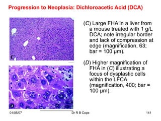 Progression to Neoplasia: Dichloroacetic Acid (DCA)

                               (C) Large FHA in a liver from
                                 a mouse treated with 1 g/L
                                 DCA; note irregular border
                                 and lack of compression at
                                 edge (magnification, 63;
                                 bar = 100 µm).

                               (D) Higher magnification of
                                 FHA in (C) illustrating a
                                 focus of dysplastic cells
                                 within the LFCA
                                 (magnification, 400; bar =
                                 100 µm).


01/05/07                Dr R B Cope                      141
 