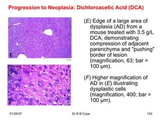 Progression to Neoplasia: Dichloroacetic Acid (DCA)

                               (E) Edge of a large area of
                                 dysplasia (AD) from a
                                 mouse treated with 3.5 g/L
                                 DCA, demonstrating
                                 compression of adjacent
                                 parenchyma and "pushing"
                                 border of lesion
                                 (magnification, 63; bar =
                                 100 µm).

                               (F) Higher magnification of
                                  AD in (E) illustrating
                                  dysplastic cells
                                  (magnification, 400; bar =
                                  100 µm).

01/05/07                Dr R B Cope                       142
 