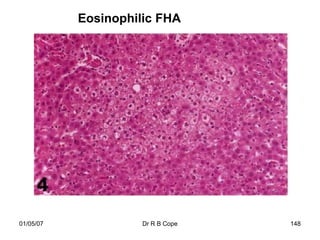 Eosinophilic FHA




01/05/07             Dr R B Cope   148
 