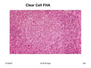 Clear Cell FHA




01/05/07           Dr R B Cope   149
 