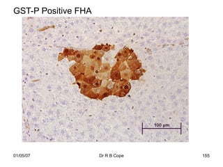 GST-P Positive FHA




01/05/07             Dr R B Cope   155
 