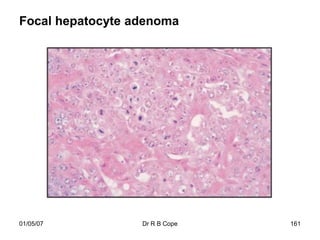 Focal hepatocyte adenoma




01/05/07          Dr R B Cope   161
 