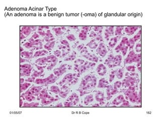 Adenoma Acinar Type
(An adenoma is a benign tumor (-oma) of glandular origin)




  01/05/07                 Dr R B Cope                      162
 
