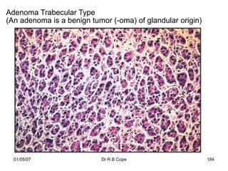 Adenoma Trabecular Type
(An adenoma is a benign tumor (-oma) of glandular origin)




  01/05/07                 Dr R B Cope                      164
 