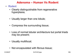 Adenoma – Human Vs Rodent
 • Rodent
    • Clearly distinguishable from regenerative
      hyperplasia;

      • Usually larger than one lobule;

      • Compress the surrounding tissue;

      • Loss of normal lobular architecture but portal triads
        may be present;

      • Usually multifocal;

      • Not encapsulated with fibrous tissue;
01/05/07                      Dr R B Cope                       165
 