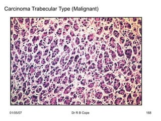 Carcinoma Trabecular Type (Malignant)




  01/05/07                Dr R B Cope   168
 