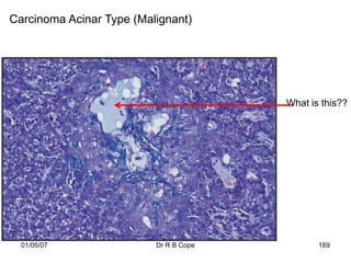 Carcinoma Acinar Type (Malignant)




                                        What is this??




  01/05/07                Dr R B Cope          169
 