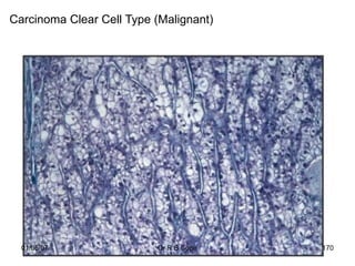 Carcinoma Clear Cell Type (Malignant)




  01/05/07                Dr R B Cope   170
 