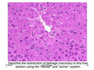Describe the distribution of damage (necrosis) in this liver
01/05/07                     Dr R B Cope                      18
         section using the “lobular” and “acinar” system.
 