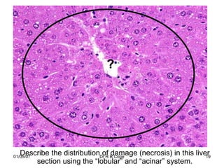 ?




   Describe the distributionDr R B Cope
01/05/07
                             of damage (necrosis) in this liver
                                                              19
       section using the “lobular” and “acinar” system.
 