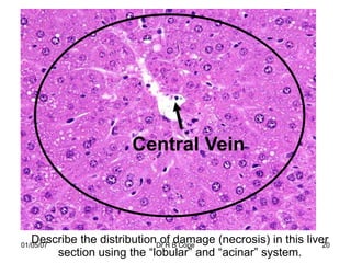 Central Vein



   Describe the distributionDr R B Cope
01/05/07
                             of damage (necrosis) in this liver
                                                              20
       section using the “lobular” and “acinar” system.
 