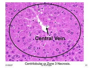Central Vein



01/05/07
           Centrilobular orB Zone 3 Necrosis.
                       Dr R Cope                21
 