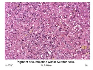 Pigment accumulation within Kupffer cells.
01/05/07                    Dr R B Cope                 28
 