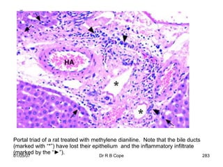 Portal triad of a rat treated with methylene dianiline. Note that the bile ducts
(marked with “*”) have lost their epithelium and the inflammatory infiltrate
(marked by the “►”).
01/05/07                            Dr R B Cope                                    283
 