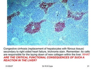 Congestive cirrhosis (replacement of hepatocytes with fibrous tissue)
secondary to right sided heart failure, trichrome stain. Remember: Ito cells
are responsible for the laying down of new collagen within the liver. WHAT
ARE THE CRITICAL FUNCTIONAL CONSEQUENCES OF SUCH A
REACTION IN THE LIVER?

 01/05/07                         Dr R B Cope                            31
 