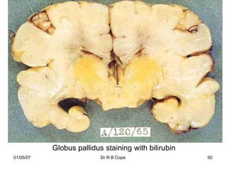 Globus pallidus staining with bilirubin
01/05/07                  Dr R B Cope                50
 