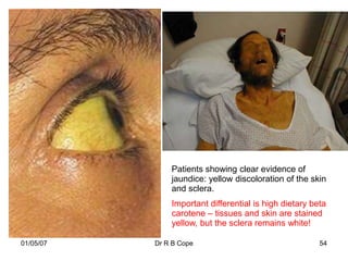 Patients showing clear evidence of
               jaundice: yellow discoloration of the skin
               and sclera.
               Important differential is high dietary beta
               carotene – tissues and skin are stained
               yellow, but the sclera remains white!

01/05/07   Dr R B Cope                                  54
 