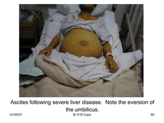 Ascites following severe liver disease. Note the eversion of
                       the umbilicus.
01/05/07                  Dr R B Cope                     59
 