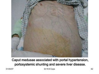 Caput medusae associated with portal hypertension,
       portosystemic shunting and severe liver disease.
01/05/07                   Dr R B Cope                     62
 