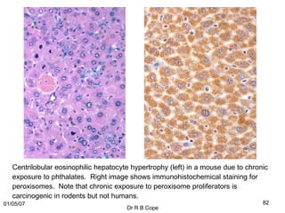 Centrilobular eosinophilic hepatocyte hypertrophy (left) in a mouse due to chronic
   exposure to phthalates. Right image shows immunohistochemical staining for
   peroxisomes. Note that chronic exposure to peroxisome proliferators is
   carcinogenic in rodents but not humans.
01/05/07                                                                           82
                                       Dr R B Cope
 