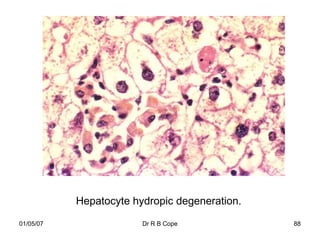 Hepatocyte hydropic degeneration.

01/05/07                Dr R B Cope            88
 