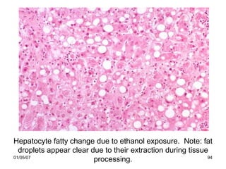 Hepatocyte fatty change due to ethanol exposure. Note: fat
  droplets appear clear due to their extraction during tissue
01/05/07
                         processing.                         94
 