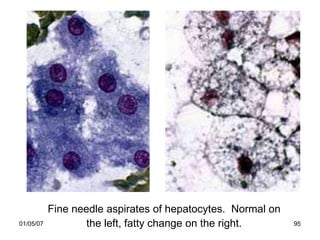 Fine needle aspirates of hepatocytes. Normal on
01/05/07           the left, fatty change on the right.      95
 
