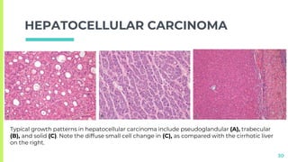 LIVER pathology. tumor and tumorlike conditions | PPTX
