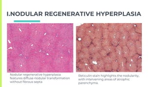 LIVER pathology. tumor and tumorlike conditions | PPTX