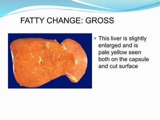  This liver is slightly
enlarged and is
pale yellow seen
both on the capsule
and cut surface
FATTY CHANGE: GROSS
 