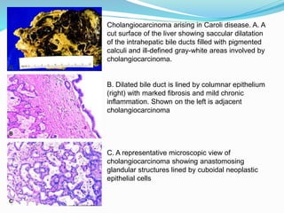 Cholangiocarcinoma arising in Caroli disease. A. A
cut surface of the liver showing saccular dilatation
of the intrahepatic bile ducts filled with pigmented
calculi and ill-defined gray-white areas involved by
cholangiocarcinoma.
B. Dilated bile duct is lined by columnar epithelium
(right) with marked fibrosis and mild chronic
inflammation. Shown on the left is adjacent
cholangiocarcinoma
C. A representative microscopic view of
cholangiocarcinoma showing anastomosing
glandular structures lined by cuboidal neoplastic
epithelial cells
 