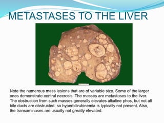 METASTASES TO THE LIVER
Note the numerous mass lesions that are of variable size. Some of the larger
ones demonstrate central necrosis. The masses are metastases to the liver.
The obstruction from such masses generally elevates alkaline phos, but not all
bile ducts are obstructed, so hyperbilirubinemia is typically not present. Also,
the transaminases are usually not greatly elevated.
 