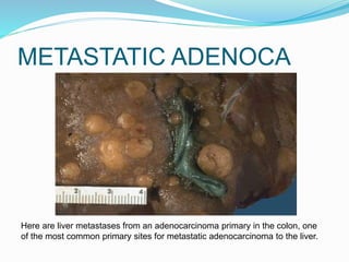 METASTATIC ADENOCA
Here are liver metastases from an adenocarcinoma primary in the colon, one
of the most common primary sites for metastatic adenocarcinoma to the liver.
 