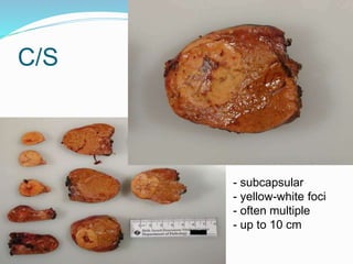 C/S
- subcapsular
- yellow-white foci
- often multiple
- up to 10 cm
 