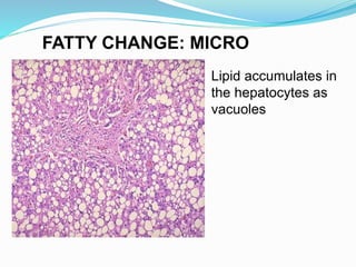 Lipid accumulates in
the hepatocytes as
vacuoles
FATTY CHANGE: MICRO
 